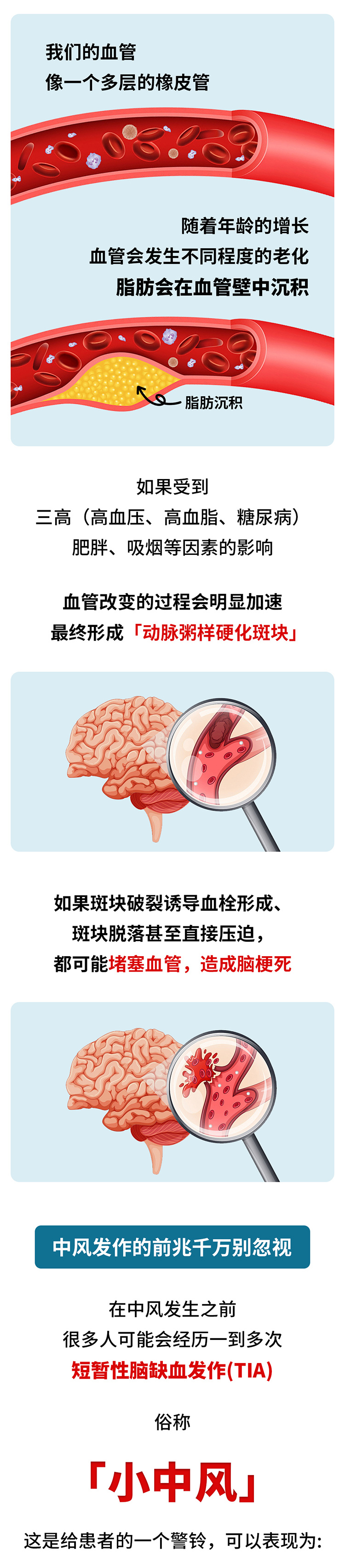 中風(fēng)的5個前兆，盡早發(fā)現(xiàn)能救命_02.jpg